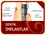 dentalimplants3